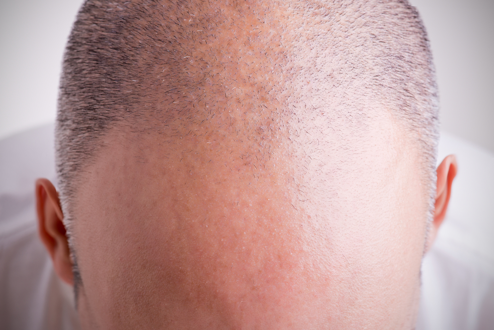 Hair loss in men and treatment for hair loss