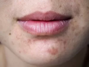 PCOS