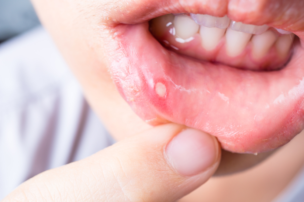 canker sore on cheek near wisdom tooth