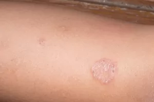 ringworm