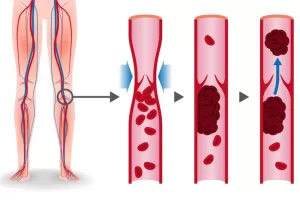 DVT