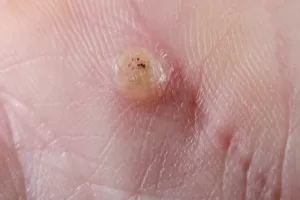 wart treatment