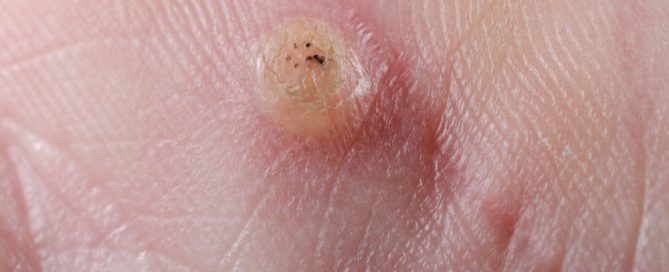 how do you get warts and what is the treatment for warts?