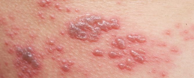 what is shingles and what are the symptoms of shingles, what does a shingles rash look like?