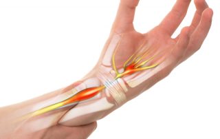 what is Carpal Tunnel Syndrome? Causes of Carpal Tunnel Syndrome