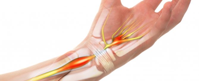 what is Carpal Tunnel Syndrome? Causes of Carpal Tunnel Syndrome