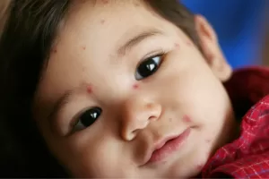 symptoms of chicken pox