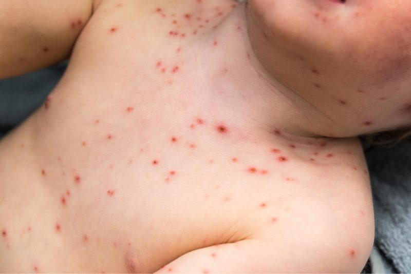 chicken-pox-symptoms-key-facts-qoctor-your-online-doctor