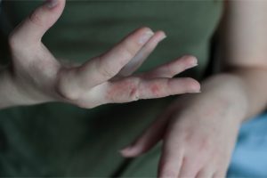 scabies rash- symptoms of scabies