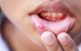 what causes mouth ulcers, are mouth ulcers contagious?