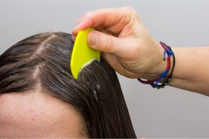 How to treat Head Lice