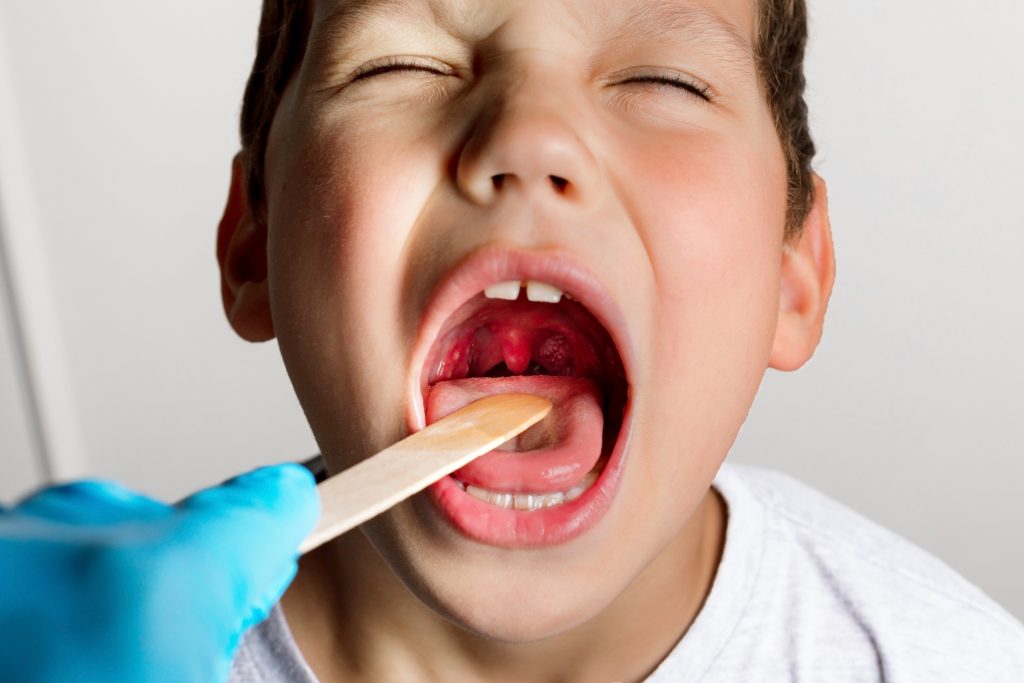 A child’s mouth is wide open with tonsils enlarged, visible in the white or yellowish tinge A child's mouth is wide open with tonsils enlarged, visible in the white or yellowish tinge