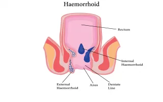 Illustration of the rectum and anal canal showing internal and external haemorrhoids