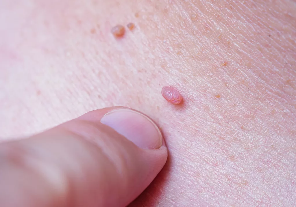 Human papilloma virus HPV on mans skin
