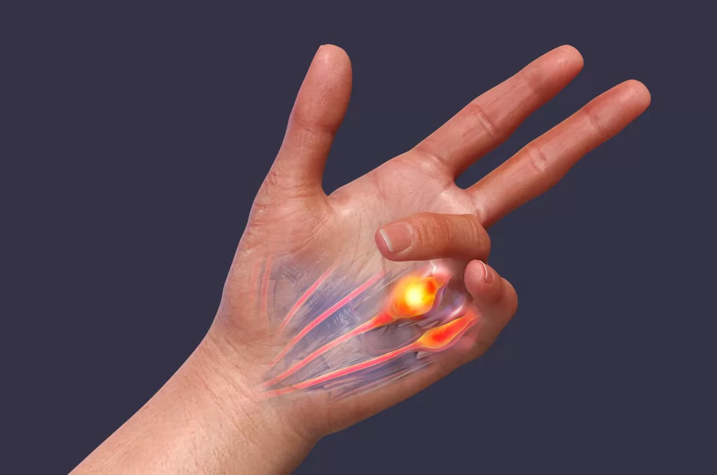 A-3D-medical-illustration-displaying-a-patients-hand-with-Dupuytrens-contracture-emphasizing-the-affected-tendons-and-palmar-fascia-to-illustrate-the-gross-pathology-of-the-condition-scaled A 3D medical illustration displaying a patient's hand with Dupuytren's contracture, emphasizing the affected tendons and palmar fascia to illustrate the gross pathology of the condition