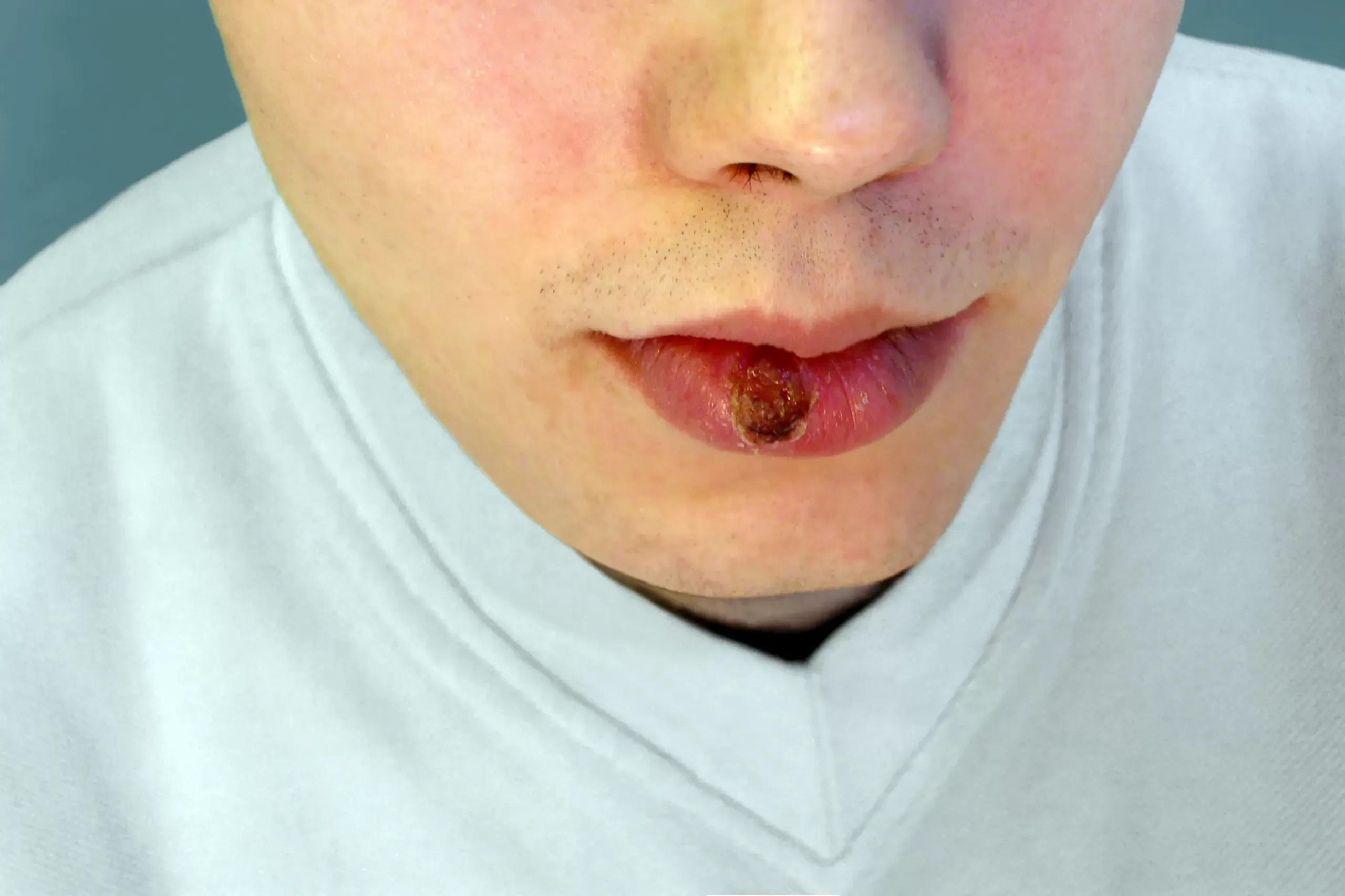 primary syphilis - indurated chancre on the lip