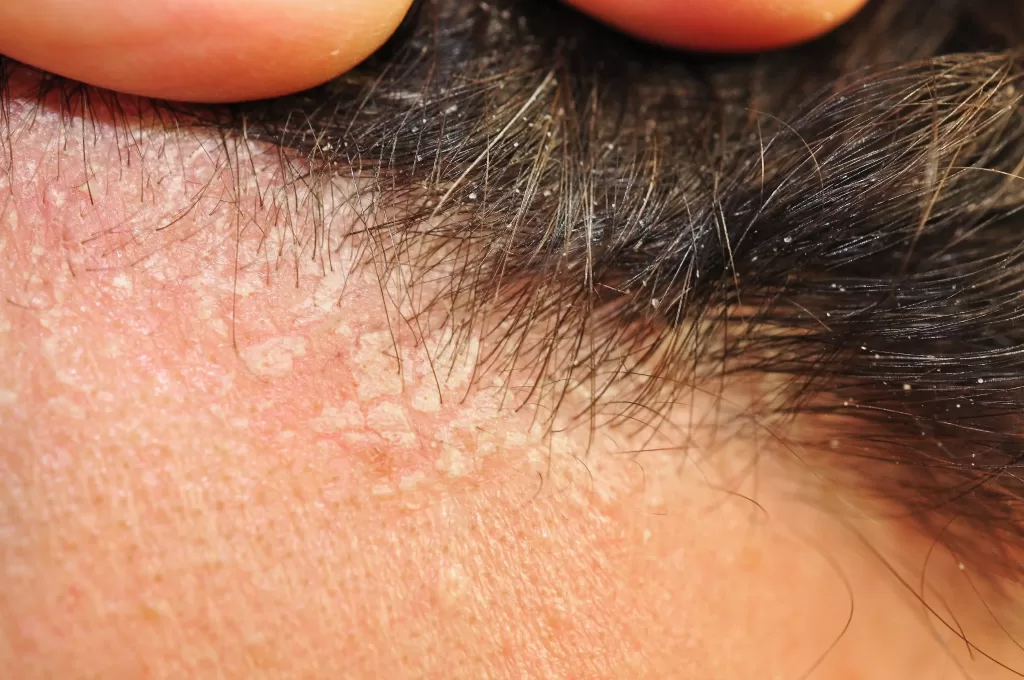 Closeup of seborrheic dermatitis disease of hair skin resulting in itchy head, white scales and dandruff