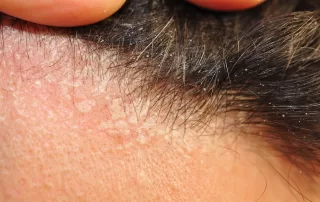 Closeup of seborrheic dermatitis disease of hair skin resulting in itchy head, white scales and dandruff