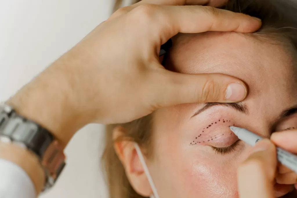 Blepharoplasty markup close-up on the face before the cosmetic surgery operation for modifying the eye region