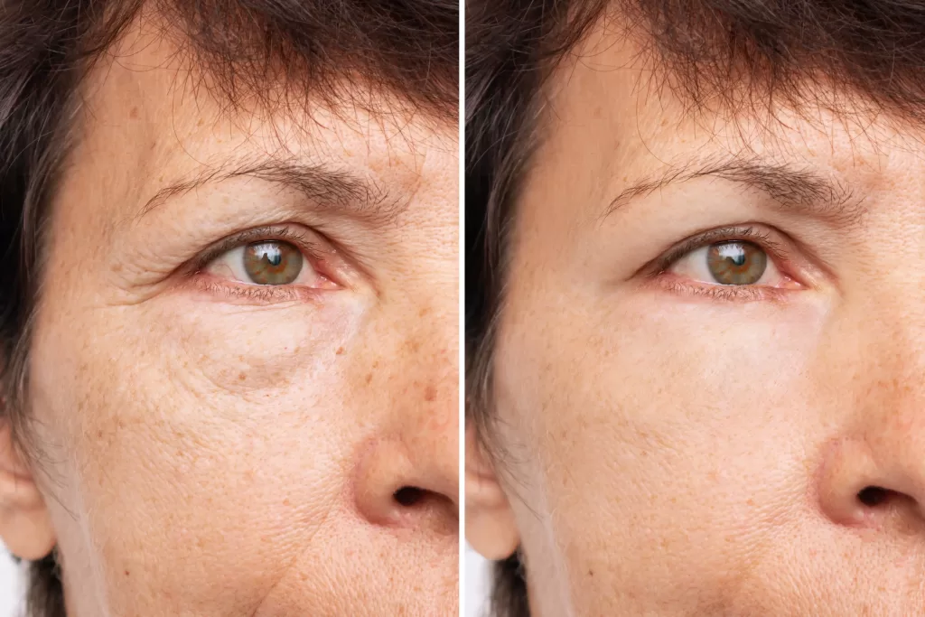 Two shots of an elderly woman's face with puffiness under her eyes and wrinkles before and after eyelid cosmetic surgery